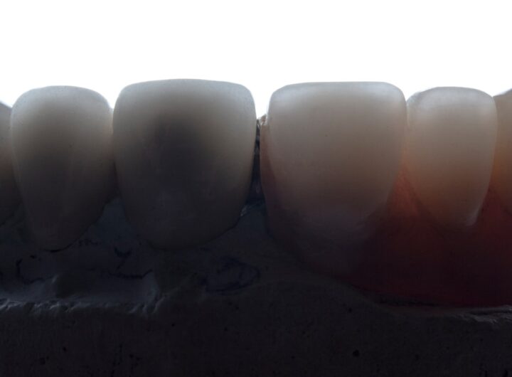 Photo Tooth falling